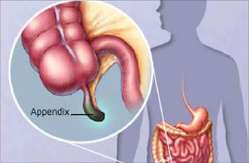 ۵ علامت هشداردهنده ترکیدن آپاندیس