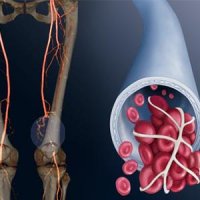 چگونه متوجه لخته خون در بدن شویم؟