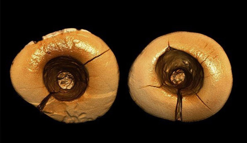 اولین دندان پر شده تاریخ کشف شد +عکس
