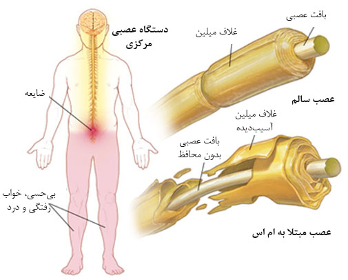 ام‌اس ناتوان کننده نیست