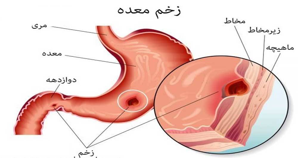 این داروها معده را نابود می‌کنند!