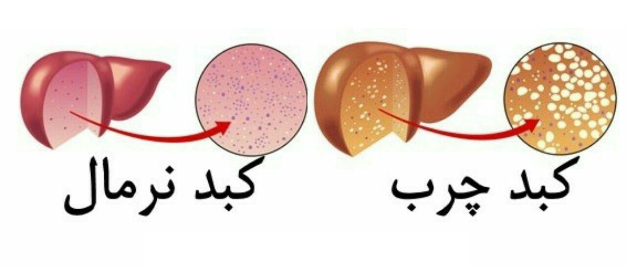 درمان کبد چرب؛ فقط با یک تغییر در رژیم غذایی