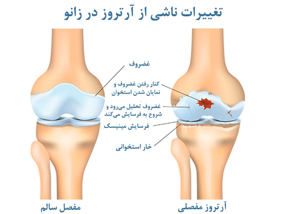 با آرتروز زانو، چه می‌توان کرد؟