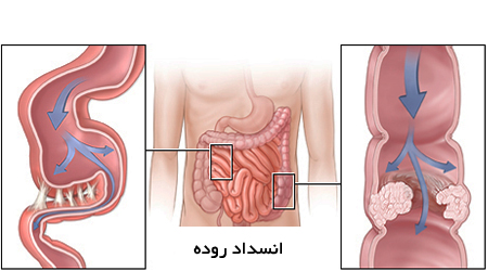 بیماری انسداد روده خطرناک است؟