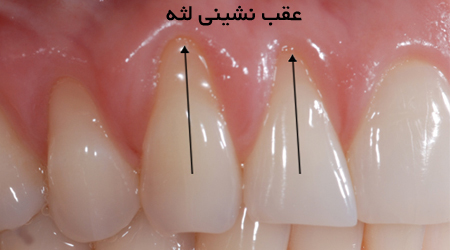 عامل‌های  عقب‌نشینی لثه‌ها؟