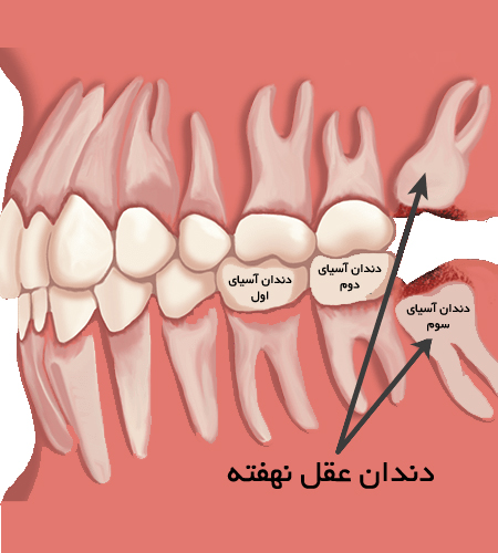 عوارض کشیدن دندان عقل چیست؟