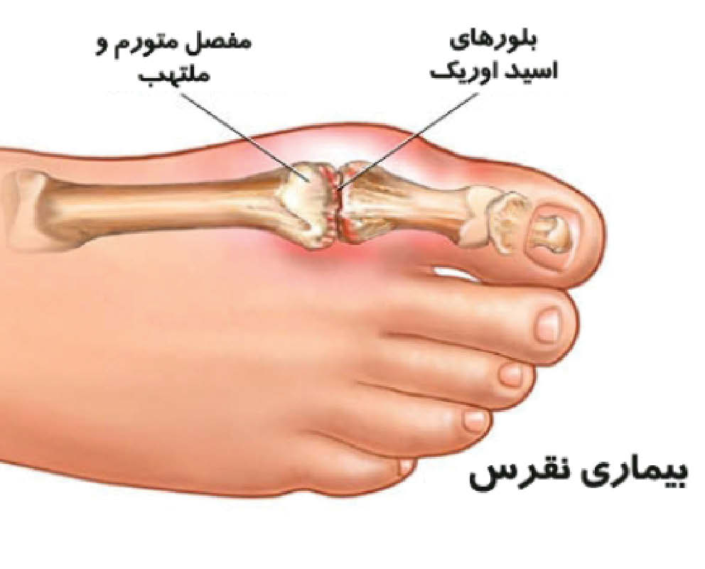 نقرس، بیماری شایع مردان