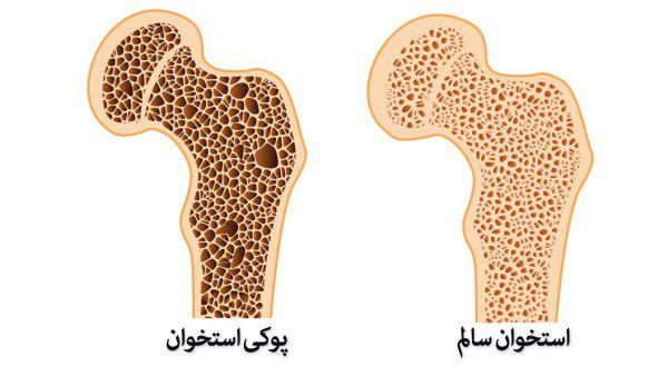 مولکول موثر در بروز پوکی استخوان، شناسایی شد