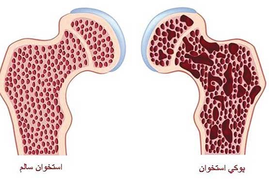 ۵ راهکار برای جلوگیری از پوکی استخوان