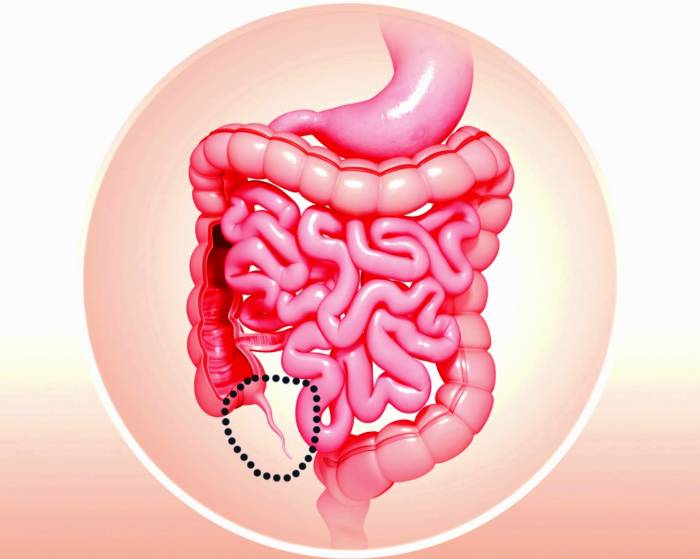 چرا مبتلا به آپاندیسیت می‌شوید؟