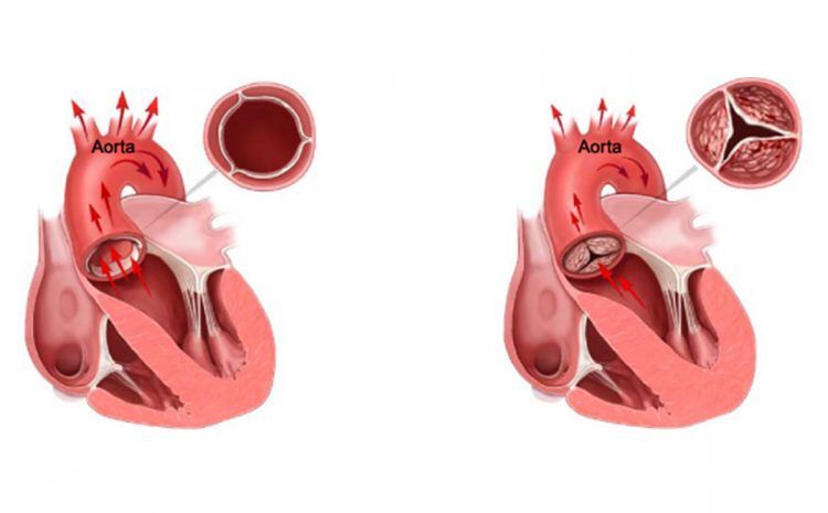 درباره بیماری تنگی دریچه آئورت بیشتر بدانید