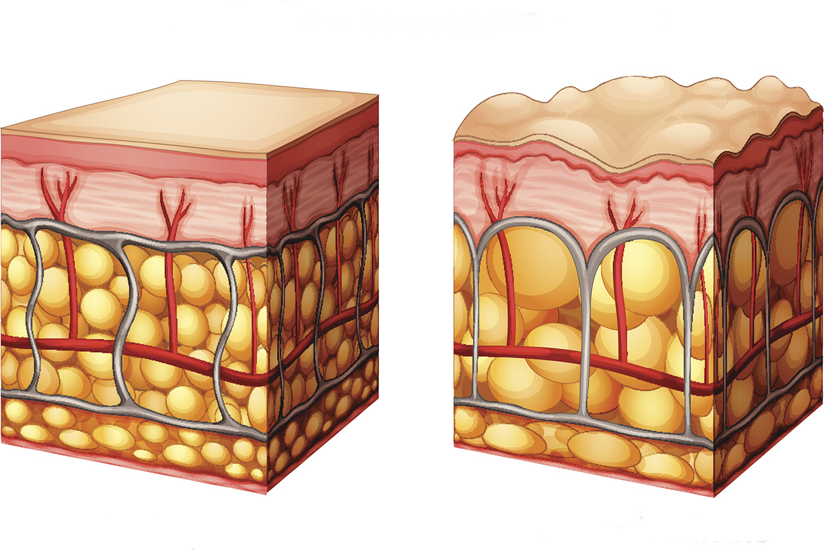 سلولیت را با این روش‌ ها از بین ببرید!