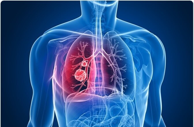 کشف روش جدید برای درمان سرطان ریه
