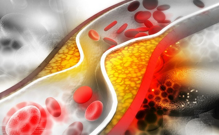 خطرات بسیار جدی بالا بودن چربی خون