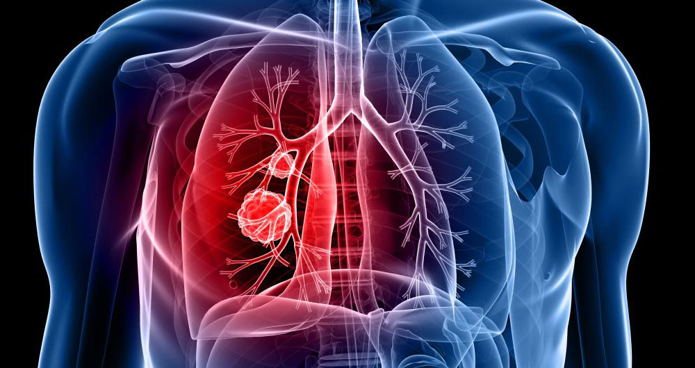 تشخیص سرطان ریه با آزمایش خون و DNA افراد