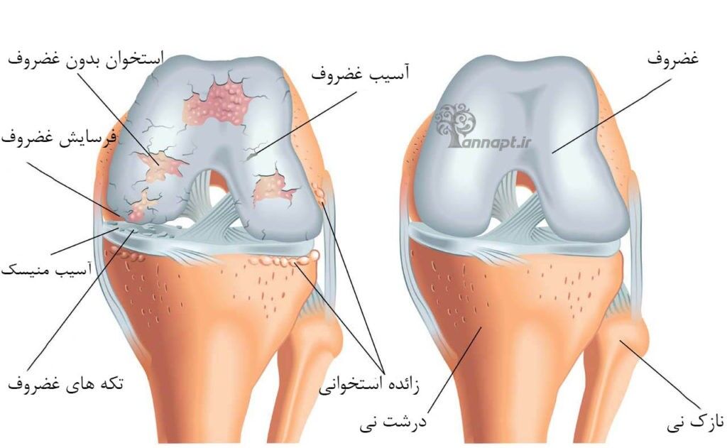 افزایش وزن و کم تحرکی آرتروز زانو را تسریع می‌ کند