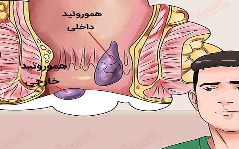 بواسیر خارجی را چگونه درمان می‌ کنند؟