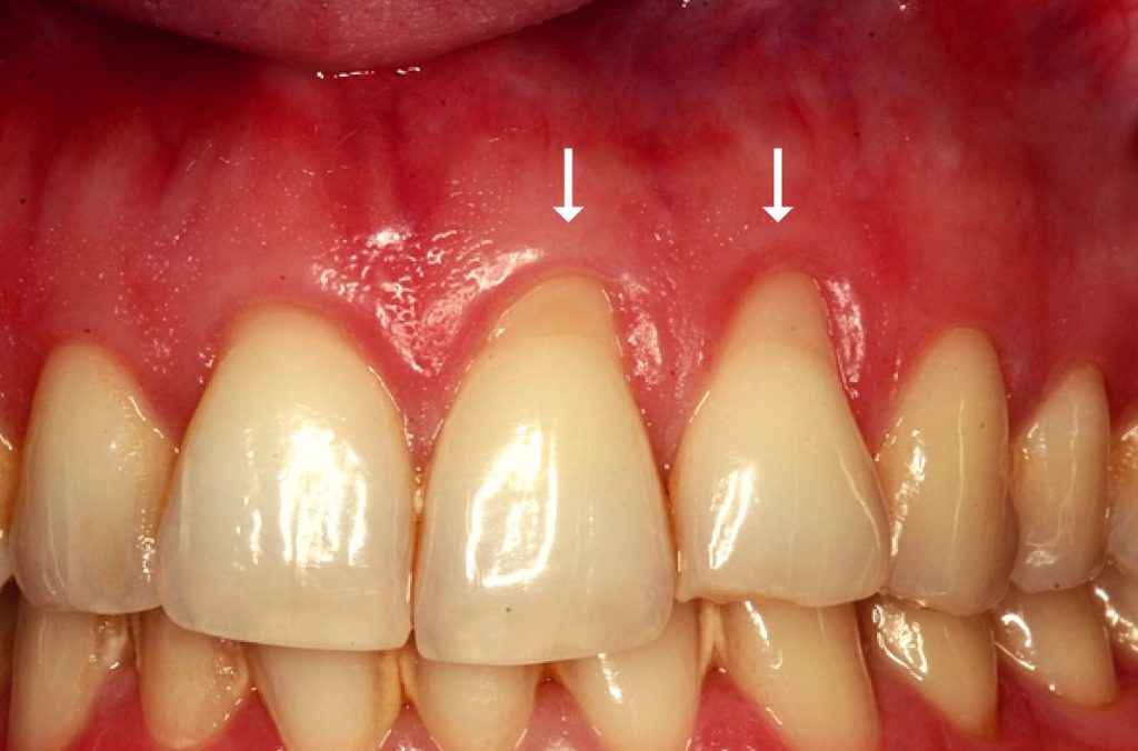 علت عقب رفتگی لثه ها چیست؟