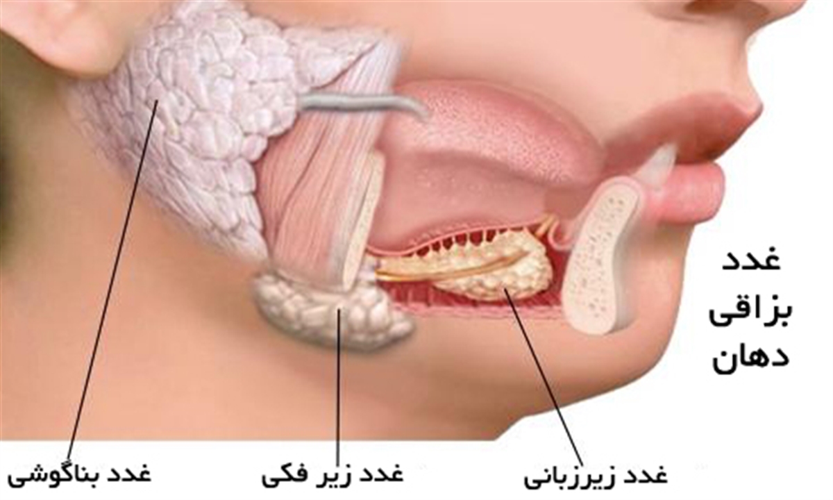 چسبندگی بزاق دهان قابل درمان است ؟