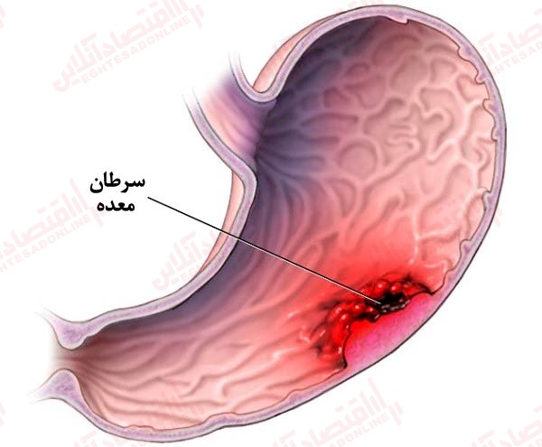 علائم سرطان معده