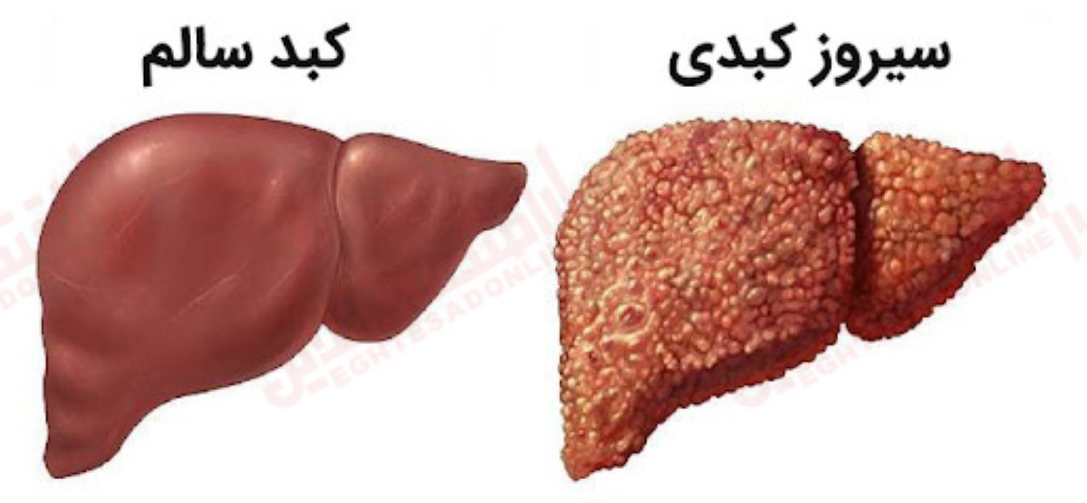 سیروز کبدی دقیقاً چه‌ کار می‌ کند