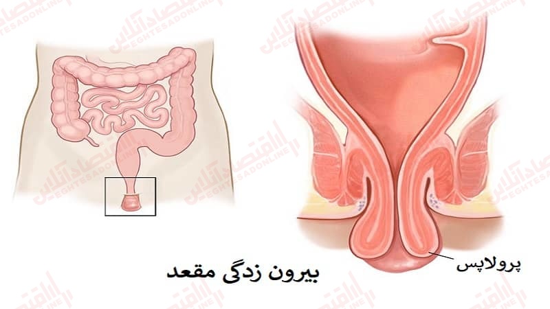 کشیده شدن پرولاپس راست‌ روده به محل