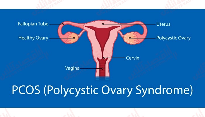 سندرم تخمدان پلی‌ کیستیک (PCOS): علائم ، علل و درمان