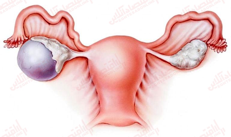 کیست تخمدان هموراژیک