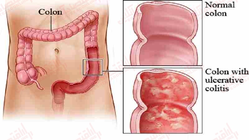 کولیت اولسروز چیست؟