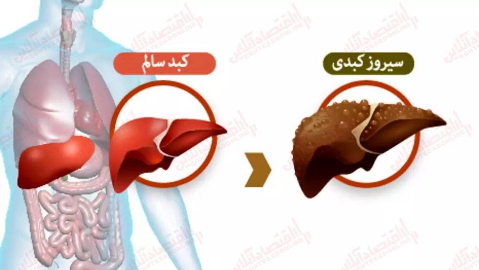 امید به زندگی در بیماران سیروز کبدی چقدر است؟