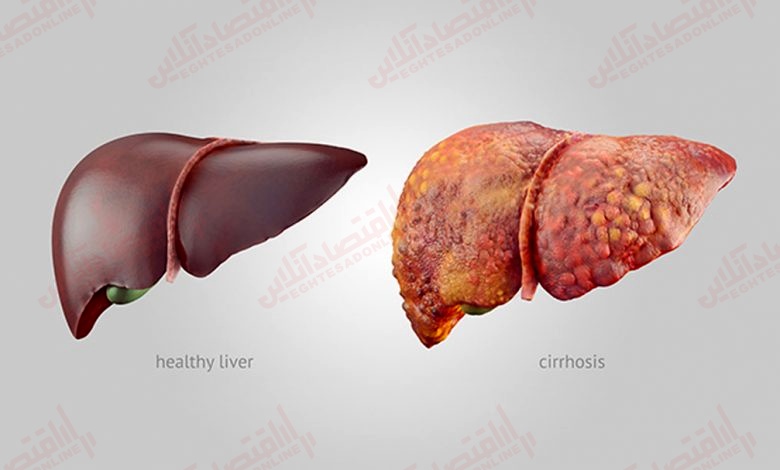 چگونه امید به زندگی  را در بیماران کبدی افزایش دهیم؟