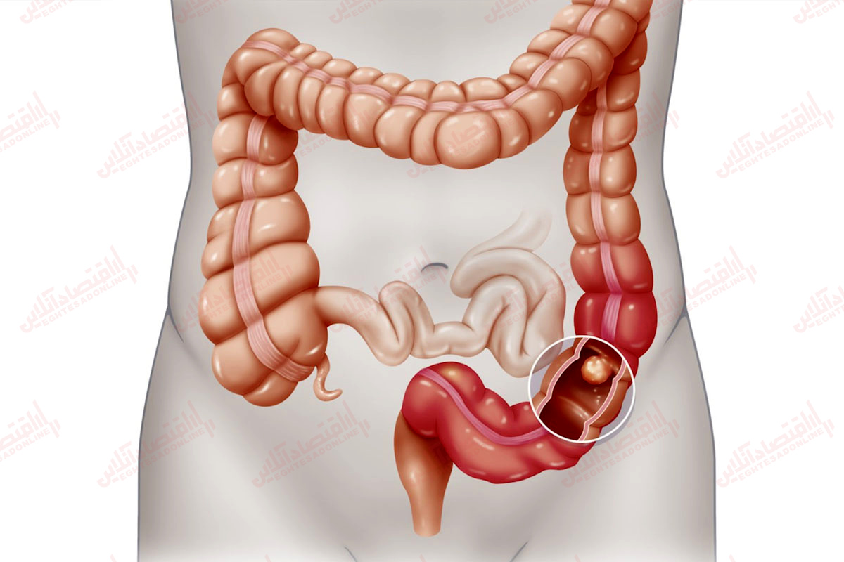 علایمی که به ایجاد سرطان روده بزرگ می انجامد