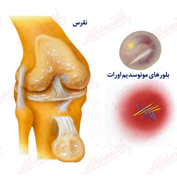 نقرس چگونه می‌ تواند روی زانو تأثیر بگذارد