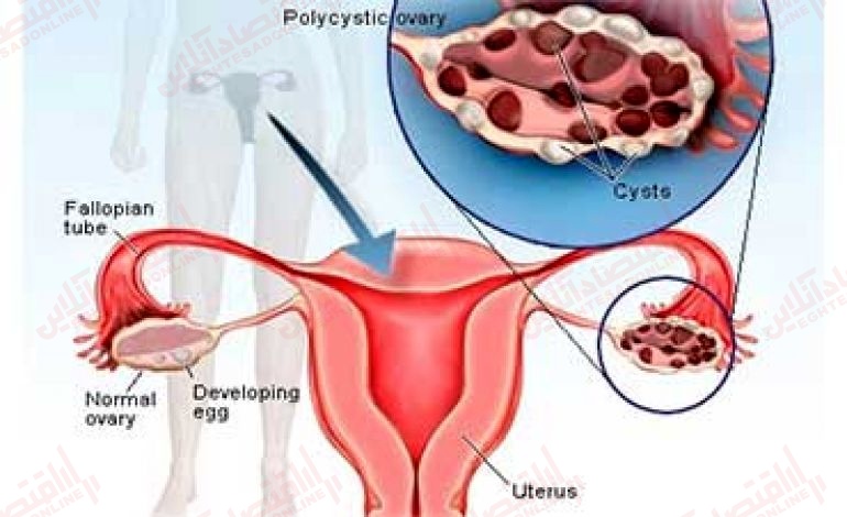 تخمدان های پلی کیستیک یا سندرم تخمدان پلی کیستیک تفاوت چیست؟
