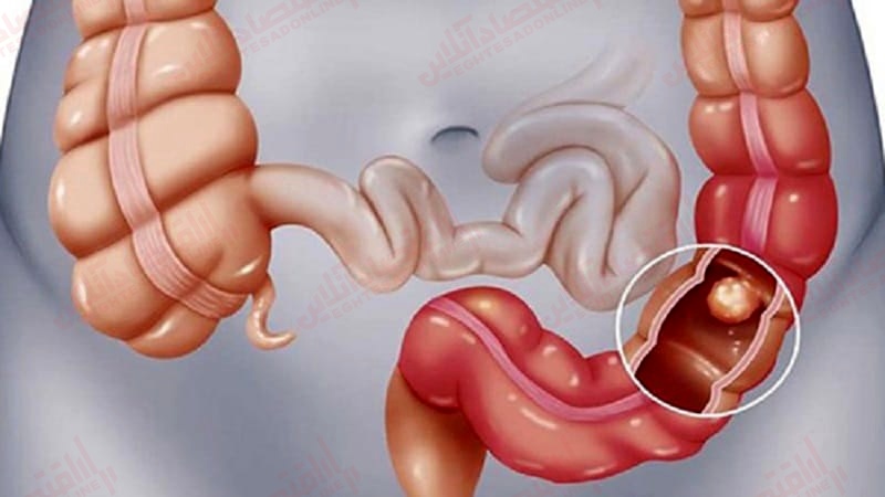 سرطان روده بزرگ: پیاده روی بر روی چوبه دار؟