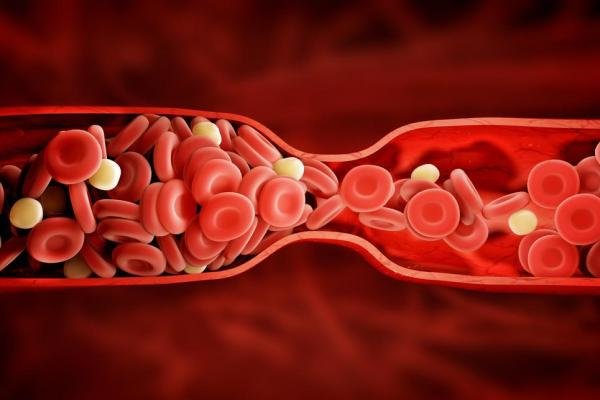 درمان گرفتگی رگ قلب با این روش