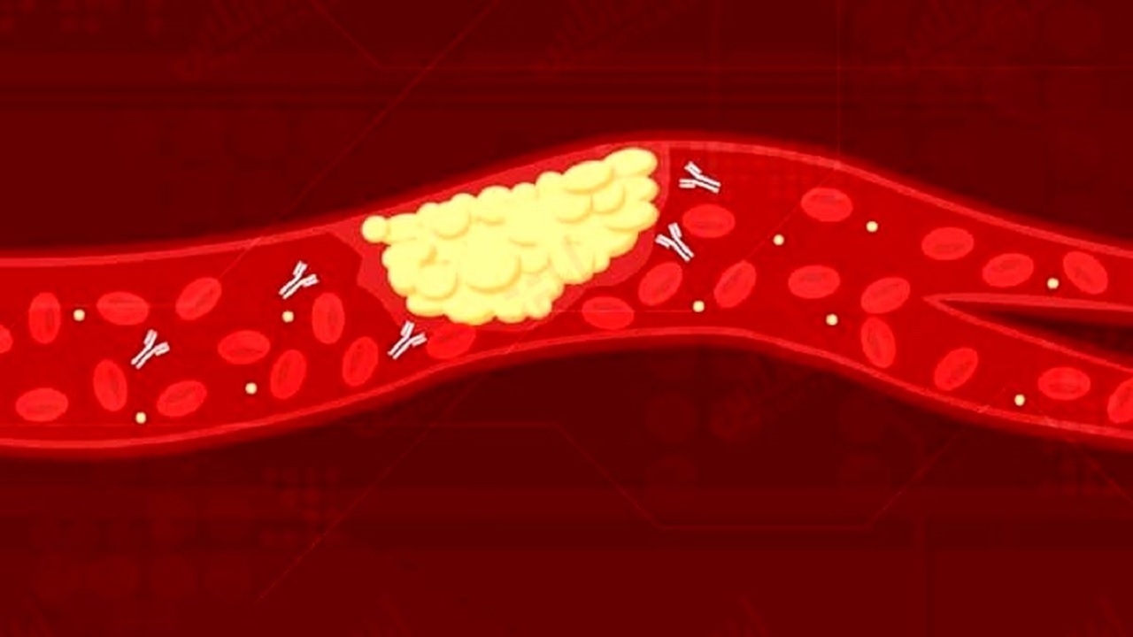 ترومبوز چیست و چرا در بیماران کرونایی اتفاق می افتد؟