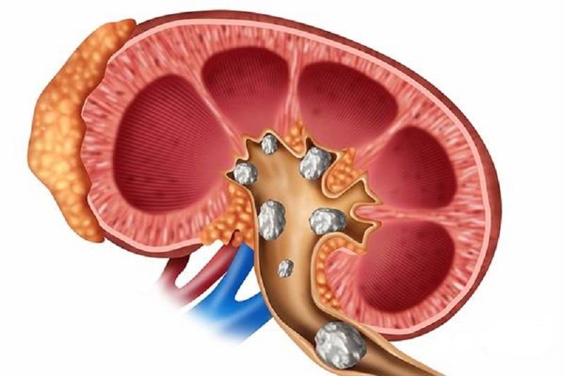 برای جلوگیری از ایجاد سنگ کلیه چه کنیم؟