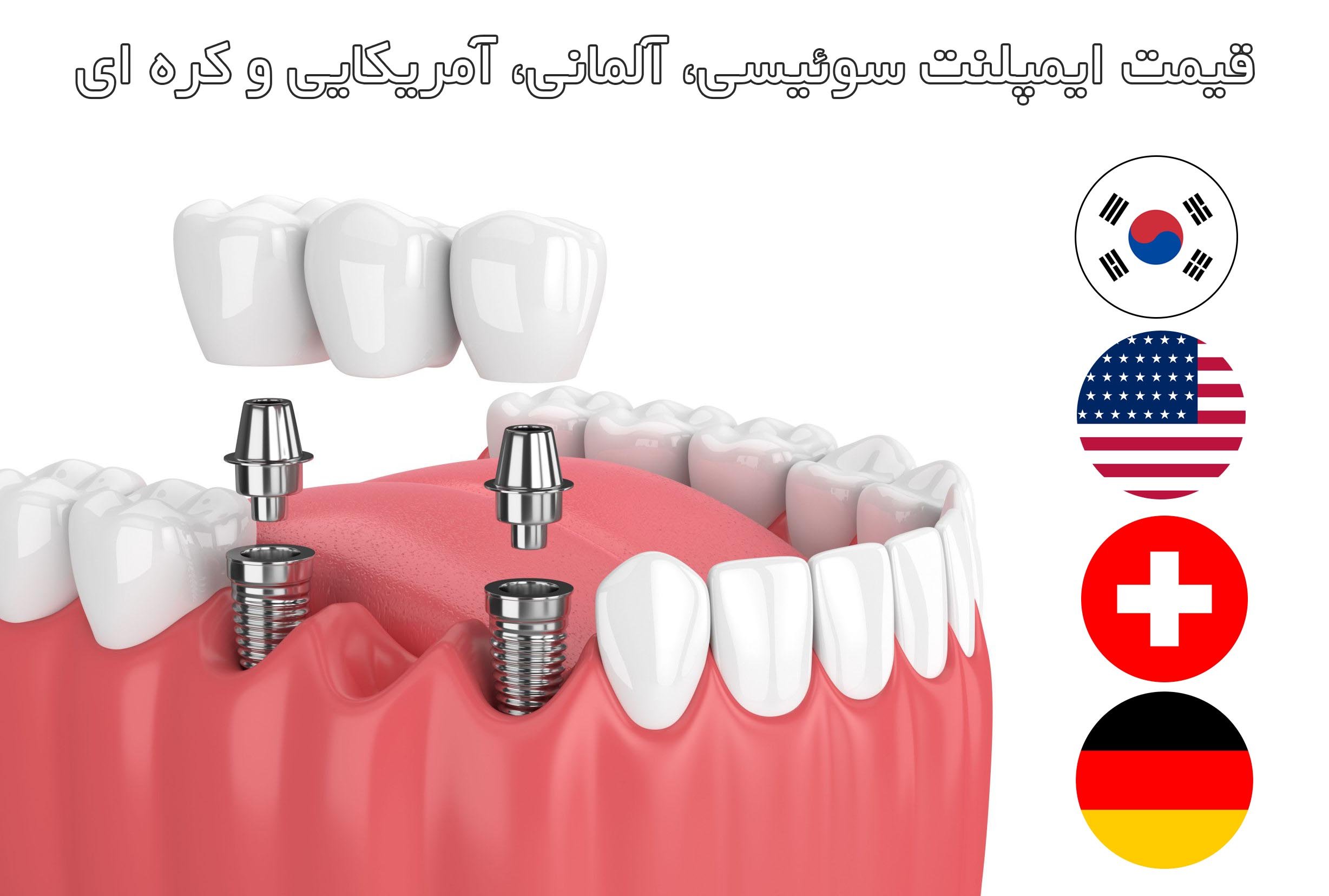 قیمت ایمپلنت سوئیسی، آلمانی، آمریکایی و کره ای