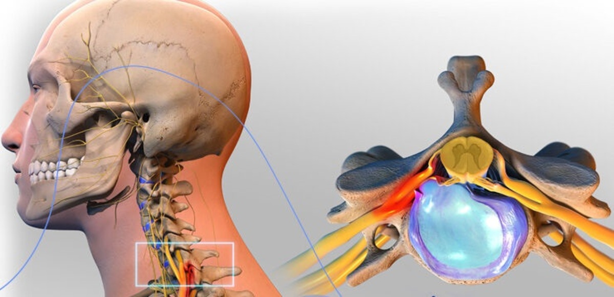 بهترین راه درمان دیسک گردن