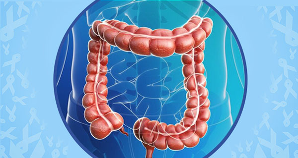 راه هایی برای پیشگیری از ابتلا به سرطان روده