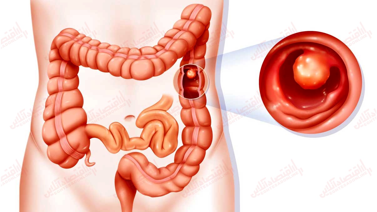همه چیز درباره پولیپ روده + نکاتی که باید به آن توجه کنید