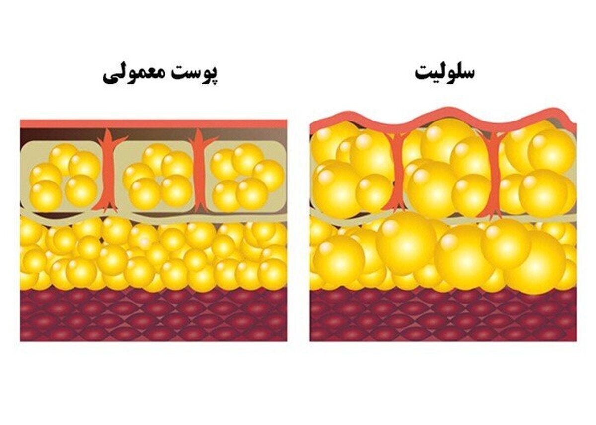  درمان‌های خانگی سلولیت که کمتر کسی از آن خبر دارد 